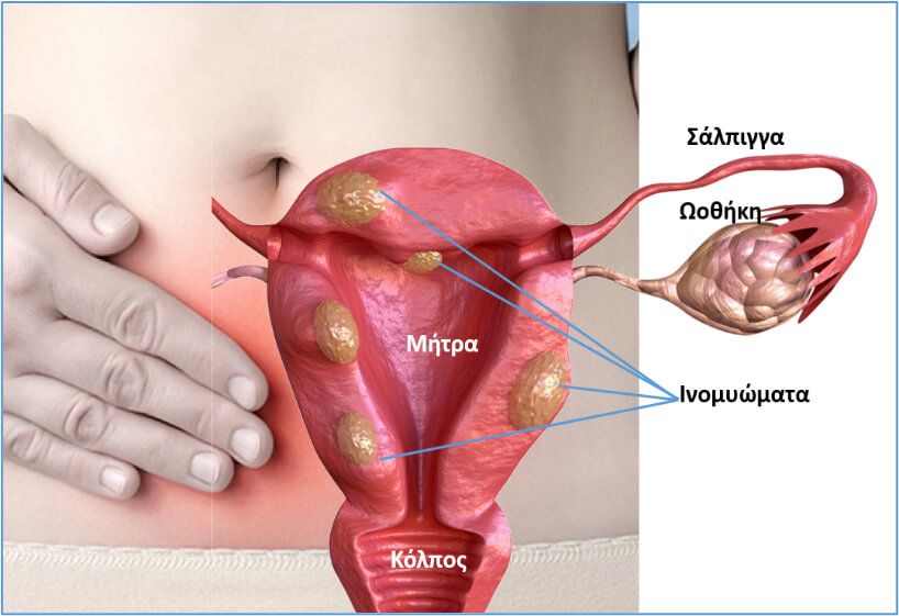 Ινομυώματα και κύηση